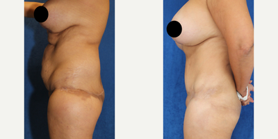 Case 1591 - 45-54 year old woman treated with Tummy Tuck
