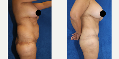 Case 1592 - 45-54 year old woman treated with Tummy Tuck