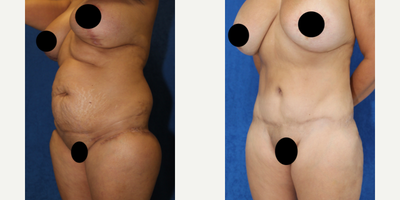 Case 1593 - 45-54 year old woman treated with Tummy Tuck