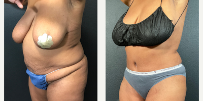 Case 1594 - Woman treated with Tummy Tuck