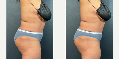 Case 1595 - Woman treated with Tummy Tuck