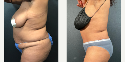 Case 1596 - Woman treated with Tummy Tuck