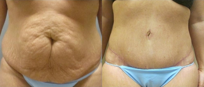 Case 1597 - Tummy Tuck