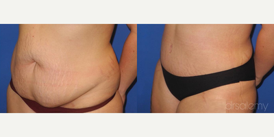 Case 1598 - Woman treated with Tummy Tuck