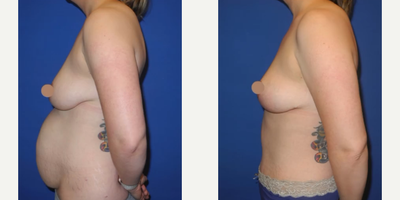 Case 1599 - Woman treated with Tummy Tuck, Liposuction