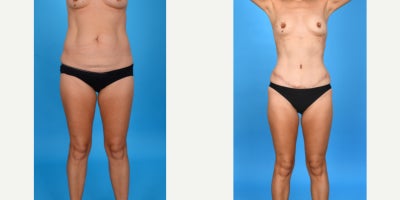 Case 16 - 35-44 year old woman treated with Abdominal Etching, Diastasis Recti Repair, Drainless Tummy Tuck, Liposculpture, Liposuction, M