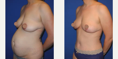 Case 1600 - Woman treated with Tummy Tuck, Liposuction