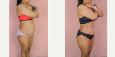 Case 1601 - 25-34 year old woman treated with Tummy Tuck, Liposuction