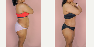 Case 1602 - 25-34 year old woman treated with Tummy Tuck, Liposuction