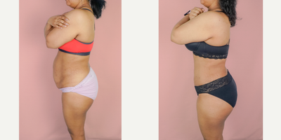 Case 1603 - 25-34 year old woman treated with Tummy Tuck, Liposuction