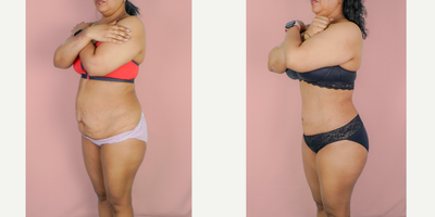 Case 1604 - 25-34 year old woman treated with Tummy Tuck, Liposuction