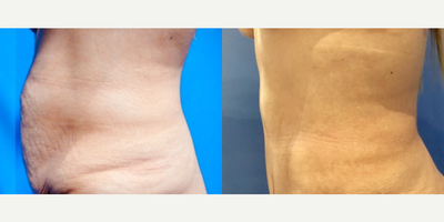 Case 1613 - Woman treated with Tummy Tuck