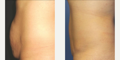 Case 1614 - Woman treated with Tummy Tuck