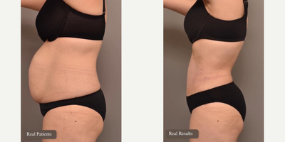 Case 1616 - Woman treated with Tummy Tuck, Liposuction