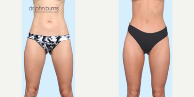 Case 162 - Woman treated with Tummy Tuck