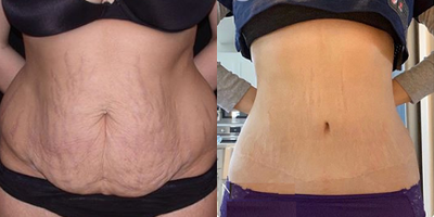 Case 1622 - Woman treated with Tummy Tuck