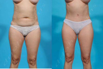 Case 1623 - 25-34 year old woman treated with Tummy Tuck