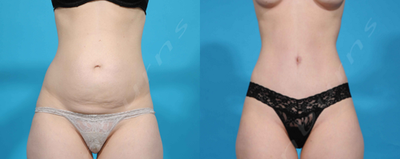 Case 1627 - 35-44 year old woman treated with Tummy Tuck