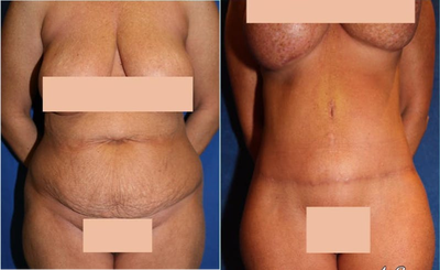 Case 1628 - Woman treated with Tummy Tuck