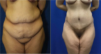 Case 1629 - Woman treated with Tummy Tuck