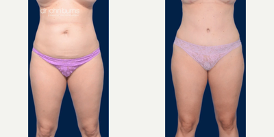 Case 163 - Woman treated with Tummy Tuck