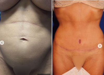 Case 1630 - Woman treated with Tummy Tuck