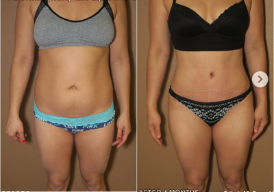 Case 1632 - Woman treated with Tummy Tuck