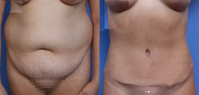 Case 1634 - Woman treated with Tummy Tuck