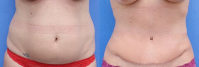 Case 1635 - Woman treated with Tummy Tuck