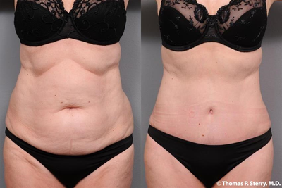 Case 1636 - 62 year old woman treated with Tummy Tuck