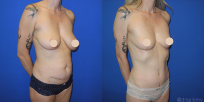 Case 1638 - Woman treated with Tummy Tuck