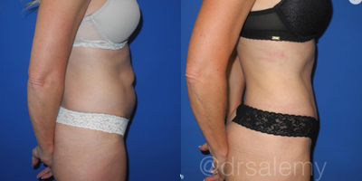 Case 1639 - Woman treated with Tummy Tuck