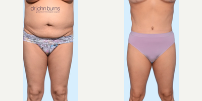 Case 164 - Woman treated with Tummy Tuck