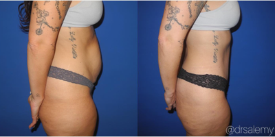 Case 1640 - Woman treated with Tummy Tuck