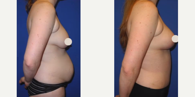 Case 1641 - Woman treated with Tummy Tuck