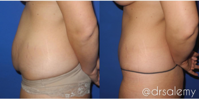 Case 1642 - Woman treated with Tummy Tuck