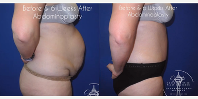 Case 1644 - Woman treated with Tummy Tuck