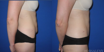 Case 1645 - Woman treated with Tummy Tuck