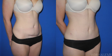 Case 1646 - Woman treated with Tummy Tuck