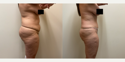 Case 1648 - Woman treated with Tummy Tuck