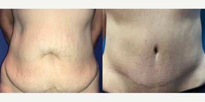 Case 165 - Woman treated with Tummy Tuck