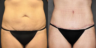 Case 1650 - 25-34 year old woman treated with Tummy Tuck