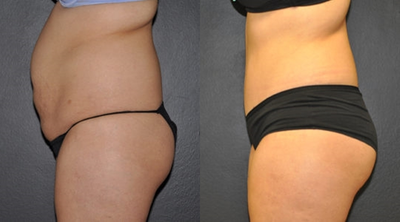 Case 1651 - 18-24 year old woman treated with Tummy Tuck