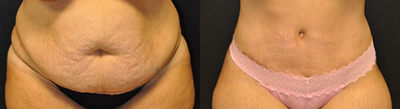 Case 1652 - 25-34 year old woman treated with Tummy Tuck