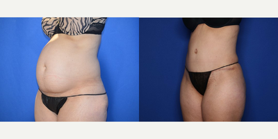 Case 1653 - 44 year old woman treated with Tummy Tuck, Liposuction