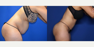 Case 1654 - 44 year old woman treated with Tummy Tuck, Liposuction