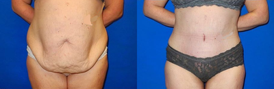 Case 1655 - Woman treated with Tummy Tuck