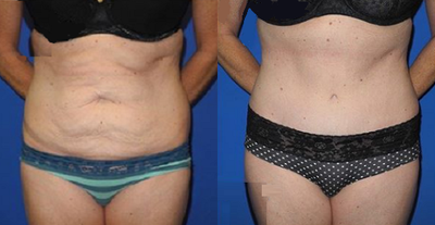 Case 1656 - Woman treated with Tummy Tuck