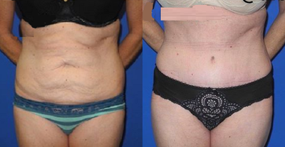 Case 1657 - Woman treated with Tummy Tuck