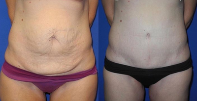 Case 1658 - Woman treated with Tummy Tuck